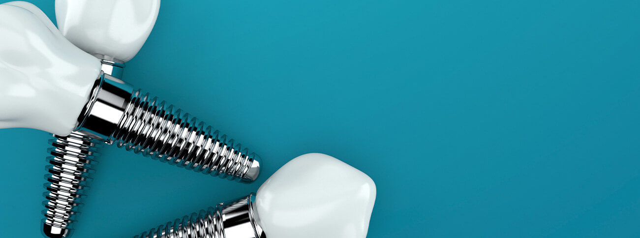 Dental Implants in Germantown, MD | River Stone Dental Center