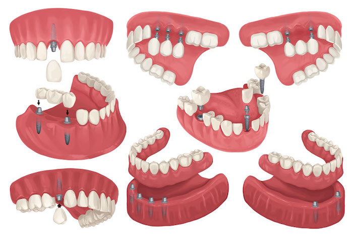 Illustrations of dental implants in Germantown, MD