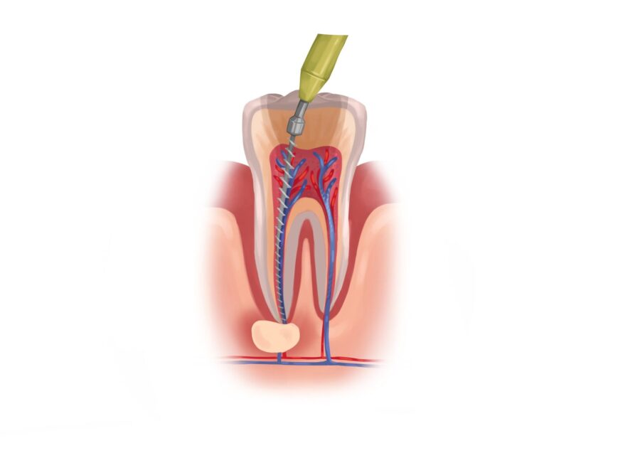 Drawing of an infected tooth receiving root canal therapy