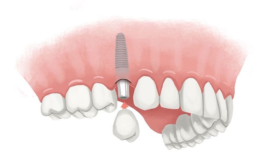 illustration of an upper jaw with a dental implant to replace a missing tooth