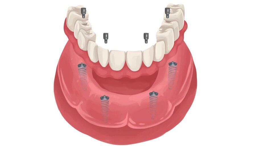 Illustration of a lower arch of dentures attaching to 4 dental implants as part of an All-On-Fours restorative procedure