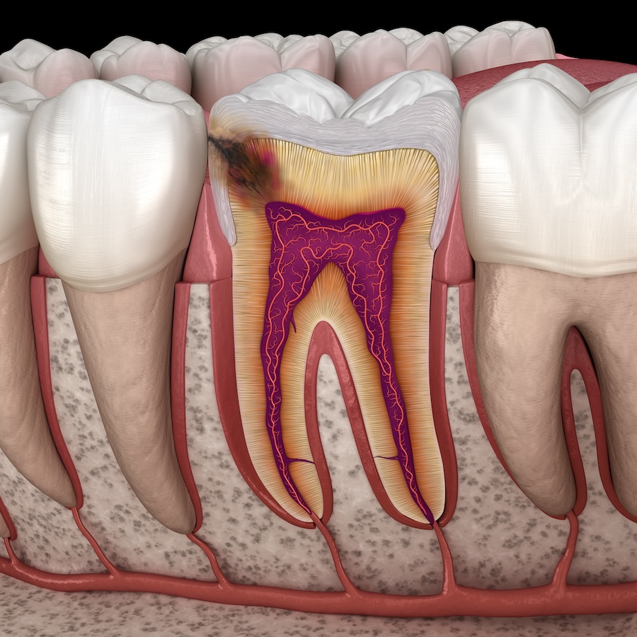 can cavities be reversed, cavity prevention, dental caries, River Stone Dental Center, Germantown dentist, Dr. Peajmun Razmjou, Dr. Sarah Heeter, dental health, fluoride treatment, remineralization