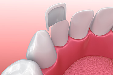 illustration of a dental veneer